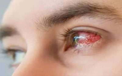 آشوب چشم سے متاثر افراد کی تعداد میں خطرناک حد تک اضافہ